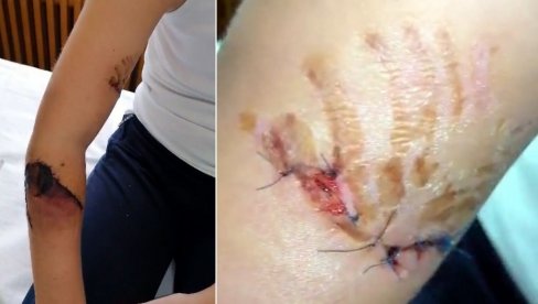 PAS IZUJEDAO KOMŠIJI RUKU: Veterinarskoj inspekciji stiglo 76 prijava napada vlasničkih pasa