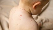 СРБИЈИ ПРЕТИ ЕПИДЕМИЈА МОРБИЛА! Педијатри упозоравају - Деца угроженија више него од короне, смањена стопа вакцинације
