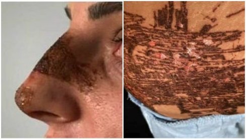 ОСЛЕПЕЛА НА ТРЕТМАНУ КОД НАДРИЛЕКАРА: Тужилаштву поднето девет кривичних пријава против лажних доктора, спремно још двадесетак