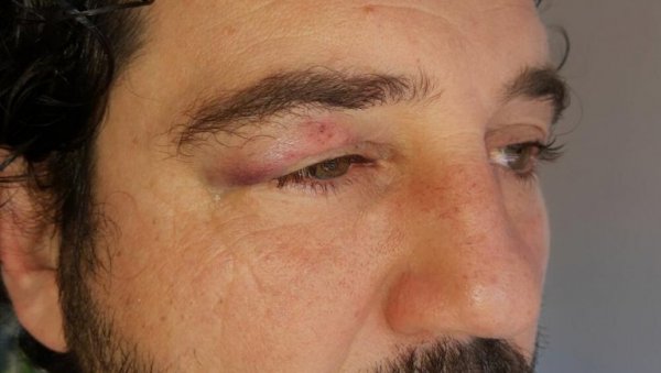 ФОТОГРАФИЈА ПРЕТУЧЕНОГ ГЛУМЦА ИЗ ИГРЕ СУДБИНЕ Миљан Давидовић: Имам модрицу испод ока - ово је разлог напада