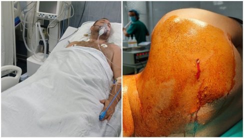 PRVE FOTOGRAFIJE SRBINA KOG SU UPUCALI ALBANCI: Srećko u bolnici nakon što su ga ustrelili u leđa (UZNEMIRUJUĆI FOTO)