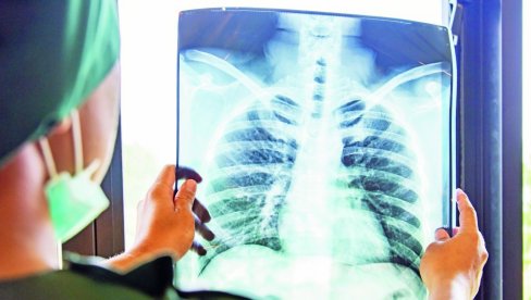RANO OTKRIĆE, BOLJA PROGNOZA: Od tipa karcinoma pluća i stadijuma zavisi da li će biti otklonjen operativno
