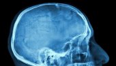 ИСТРАЖИВАЊЕ ПОКАЗАЛО: Пацијенти хоспитализовани због ковида могу да имају компликације на мозгу
