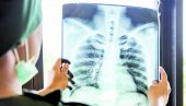 SMRTNOST OD TBC U PORASTU: Zabrinjavajući podaci o broju preminulih od tuberkuloze