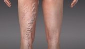 ПРОШИРЕНЕ ВЕНЕ НИСУ САМО ЕСТЕТСКИ ПРОБЛЕМ: Посматрајте своје ноге - Због поремећеног протока крви већи ризик од појаве тромба
