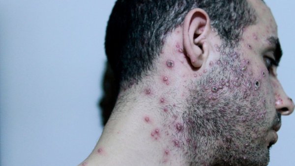 ПРВИ СМРТНИ СЛУЧАЈ ОД МАЈМУНСКИХ БОГИЊА У ЛА: Реч о особи веома слабог имунитета