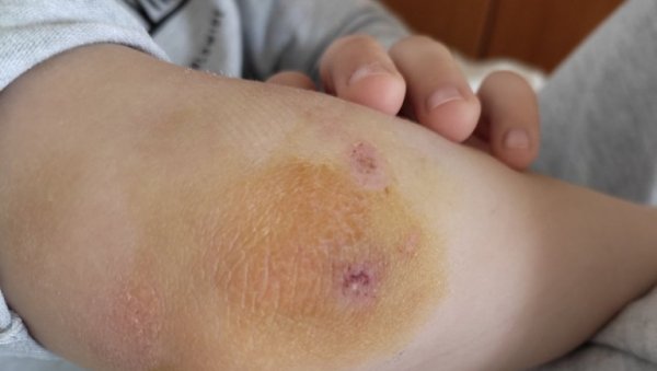 ЦЕЛА ПОРОДИЦА ТАЛАЦ СТАФОРДА: У Народних хероја су немоћни пред комшијама које имају опасног пса