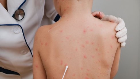 ПРВИ СЛУЧАЈ МАЛИХ БОГИЊА РЕГИСТРОВАН У СРБИЈИ: Дете има 14 година и није вакцинисано ММР вакцином
