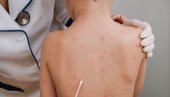 TRUDNICA OBOLELA OD MORBILA: Prete nam zauške i rubela - svaki deseti dečak inficiran mumps virusom