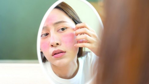 LICE SE NE CRVENI SAMO ZBOG TOPLOTE: Proverite sa dermatologom da nemate kuperozu
