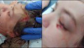 PITBUL IZUJEDAO DEVOJČICU (7) U PRIJEPOLJU: Nesrećno dete krvavog lica prebačeno u užičku bolnicu (UZNEMIRUJUĆI FOTO)