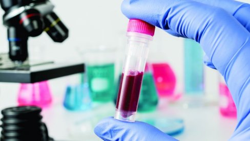 VEGF TEST SPASAVA ŽIVOT: Iz jednog uzorka krvi otkriva se 160 vrsta karcinoma