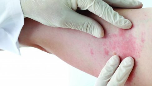 TIFUS JE ZARAZA KOJA SE BRZO ŠIRI: Prvi simptomi se pojave tek posle sedam dana - ishod može biti fatalan