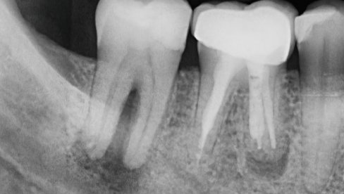 NAUČNICI OTKRIVAJU: Kako lažni zubi mogu poslužiti kao slušni aparat