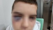 DEČAKU OKO MODRO I ZATVORENO: Otac iz Surdulice prijavio da mu je dete (15) žrtva vršnjačkog nasilja (FOTO)