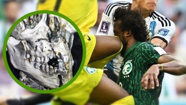 ЗА ЊЕГА ЈЕ МУНДИЈАЛ ЗАВРШЕН: Стравичнан рендгенски снимак главе саудијског фудбалера је ипак лажан (ВИДЕО)