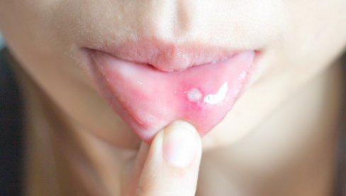 TREBA IM DO ŠEST NEDELJA DA ZARASTU: Ispiranje usta pomaže zaceljenju afti