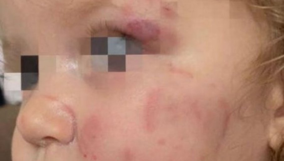 DETE IZUJEDALO VRŠNjAKINjU U VRTIĆU: Užas u Smederevu - Devojčica sa ozbiljnim povredama hitno primljena u bolnicu