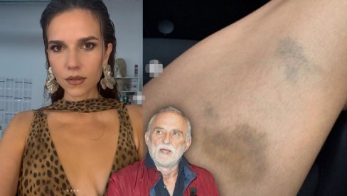 СВЕ ИЗНЕЛА ЈАВНО Лазина Аница објавила фотографије у огромним модрицама: Боли! (ФОТО)