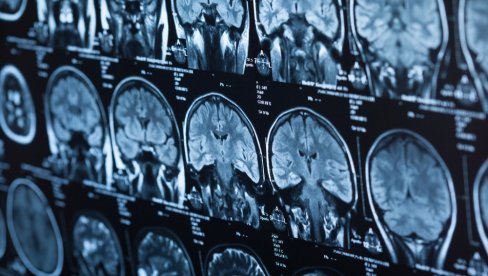 NAUČNICI OTKRILI ŠTA SE DEŠAVA POSLE SMRTI: Mozak zadržava stepen svesti nakon što lekari proglase pacijenta mrtvim