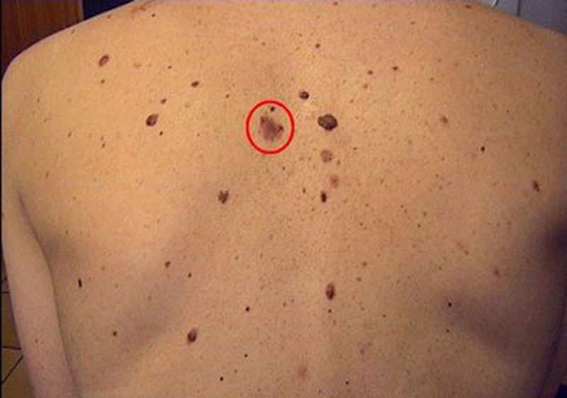 Заблуде о младежима и меланому