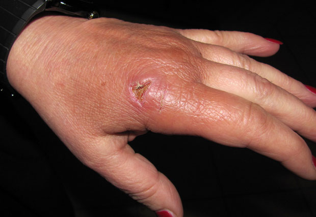 Kлештима јој откинуо део руке