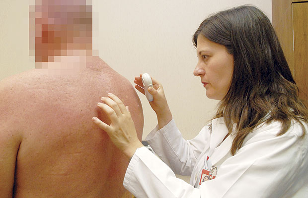 Рак коже лечимо као пре 40 година