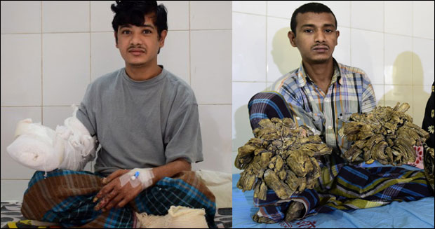 „Човек-дрво“ излечен после 16 операција (ВИДЕО)