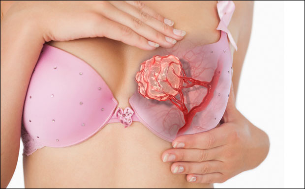 АЛАРМАНТНО: Од рака дојке годишње умре око 1.700 жена