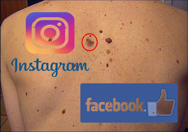  Инстаграм и Фесбук повећавају број обољелих од рака коже