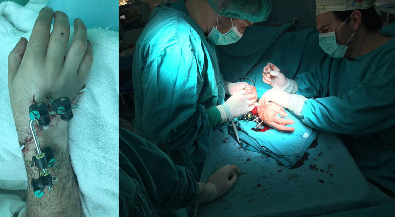 Бањалучки лекари пришили шаку! 