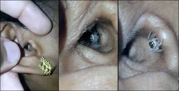 ЈЕЗИВ СНИМАК: Паук излази из жениног уха (ВИДЕО)