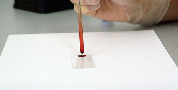 ОБРАТИТЕ ПАЖЊУ: Модрице и дуга крварења аларм да се посумња на хемофилију