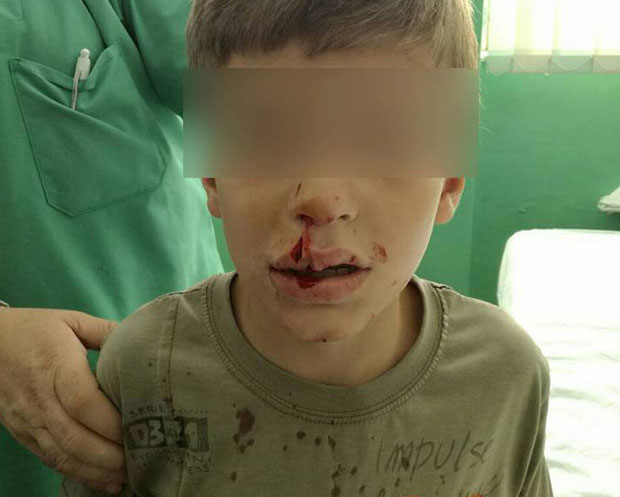 После уједа пса, детету чак осам копчи на лицу