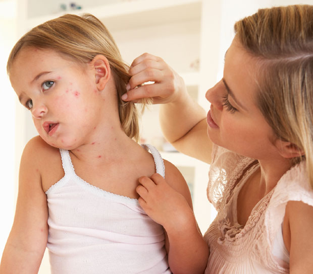 Батут: У Србији регистровано 707 случајева малих богиња