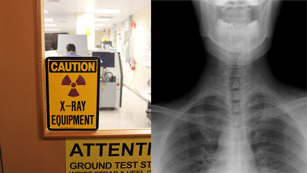 РАСПРАВА У НЕМАЧКОЈ: Рендгеном утврђивати старост миграната?