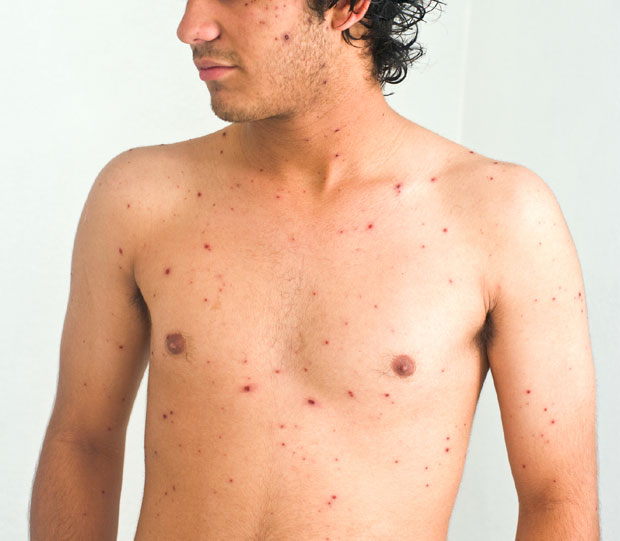 Хрватска у страху од епидемије малих богиња