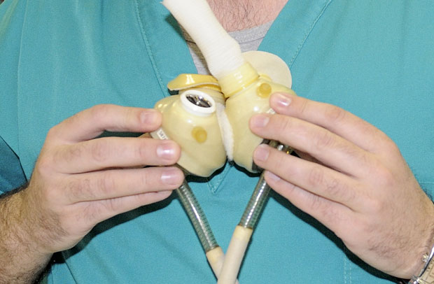 Малој Рити (4) уграђено механичко срце