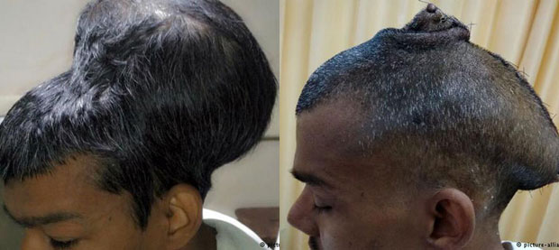 Хирурзи у Индији уклонили тумор на мозгу тежак скоро два килограма
