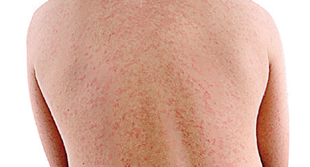 Источно Сарајево: Епидемија морбила