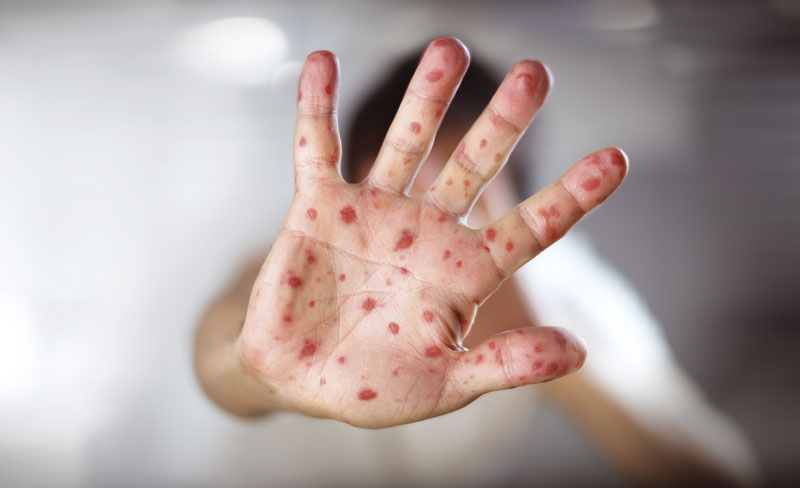 ПОВРАТАК МОРБИЛА: Вакцина једина заштита!