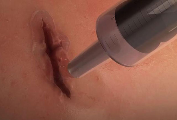 РЕВОЛУЦИОНАРНО ОТКРИЋЕ: Научници створили хируршки лепак који затвара ране за један минут (ВИДЕО)