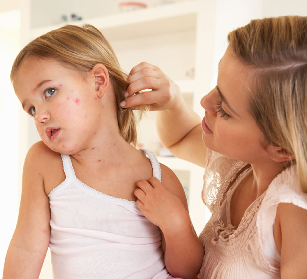 ЕПИДЕМИЈА МОРБИЛА У РС: На удару најмлађи