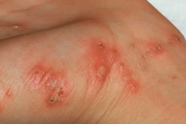 Мулаомеровић: Нема епидемије шуге