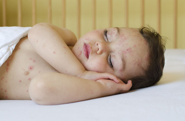 Од октобра до јуна 5.492 случаја малих богиња, преминуло 15