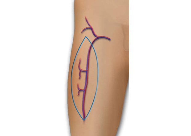 ПОДВИГ НА ВМА: Направили језик од режња натколенице
