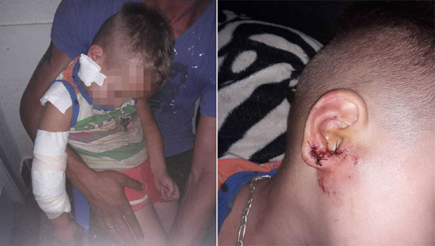 Чопор изуједао двогодишњака!