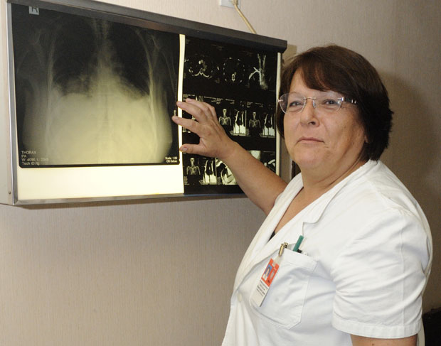 Кад захвати унутрашње органе, лупус мора агресивно да се лечи