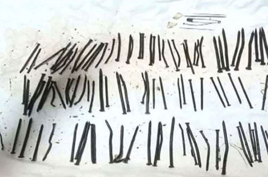 БИЗАРНО: Лекари извадили 122 ексера из желуца пацијента