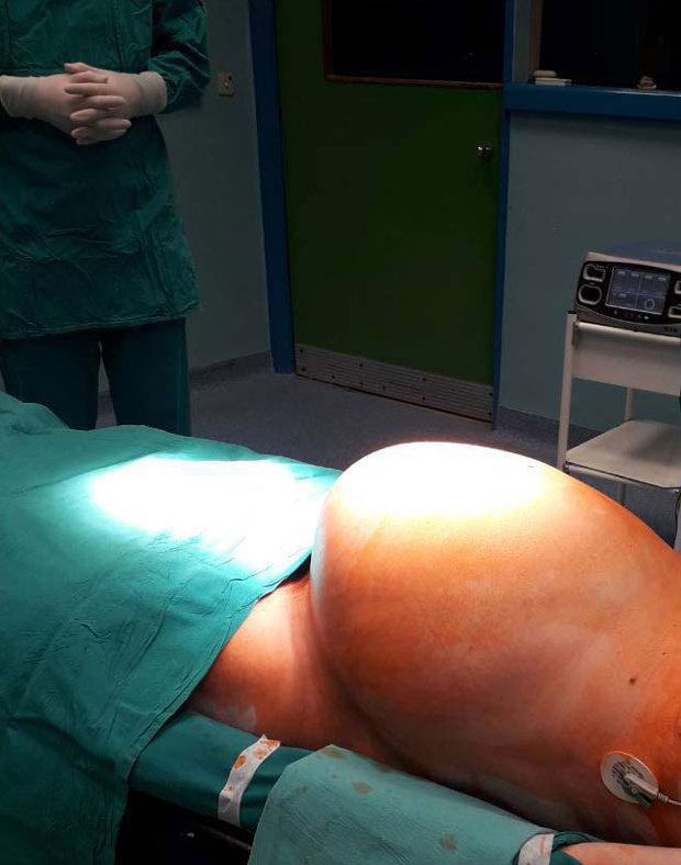 УСПЕХ ЛЕКАРА У РС: Одстранили тумор од 30 килограма